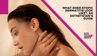 An esthetician client wonders what does atopic dermatitis look like and do I have it?